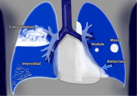 suspicious densities in both upper lobes|The Radiology Assistant : Chest X.